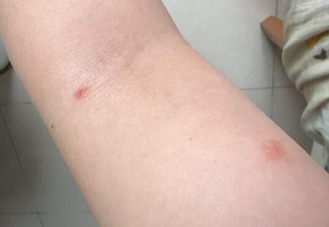 被肿腿蜂叮咬
